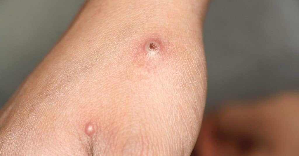 mpox op arm