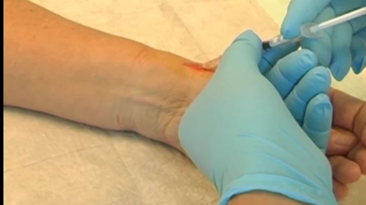 Instructiefilm De Quervain tendovaginitis injectie