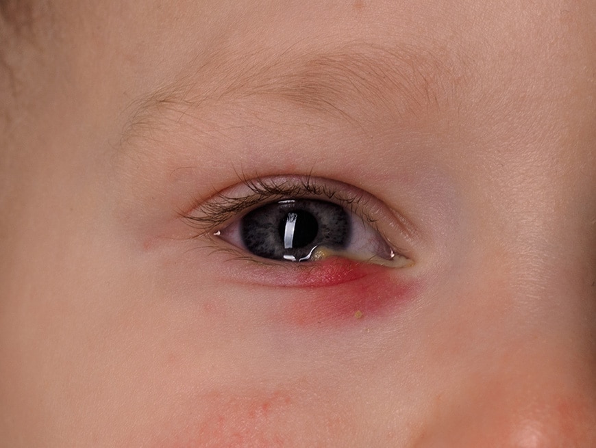 kind met een rood oog