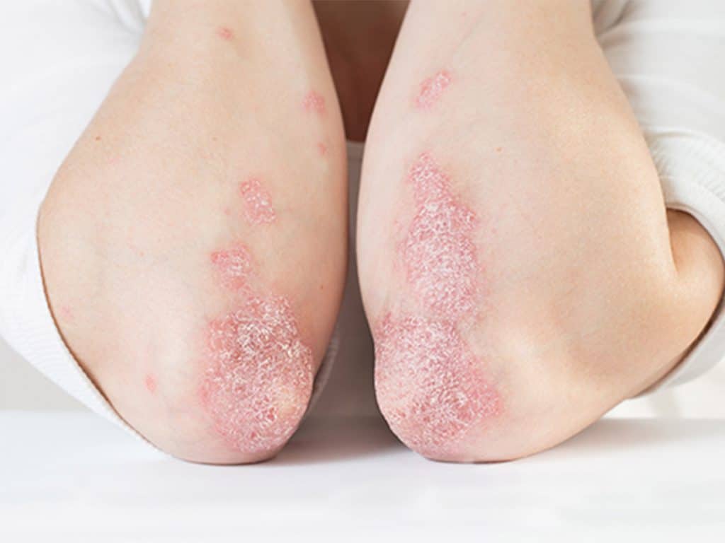 armen met psoriasis