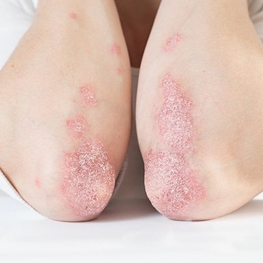 armen met psoriasis