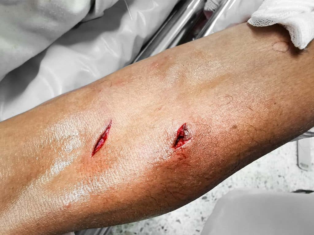 arm met bijtwonden